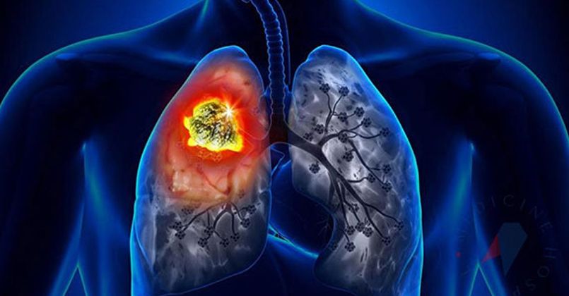 Akciğer kanseri erkelerde görünme sıklığı olarak 1'inci sırada