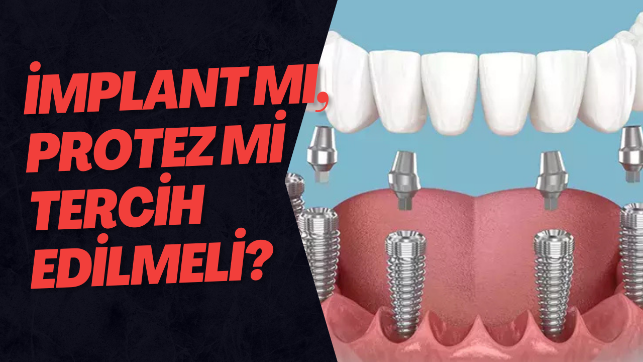 İmplant Mı, Protez Mi Tercih Edilmeli?