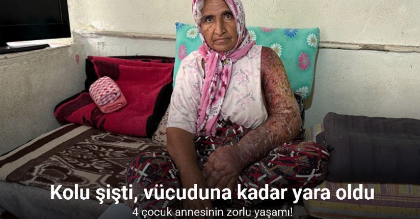 Kolu şişti, vücuduna kadar yara oldu: 4 çocuk annesinin zorlu yaşamı