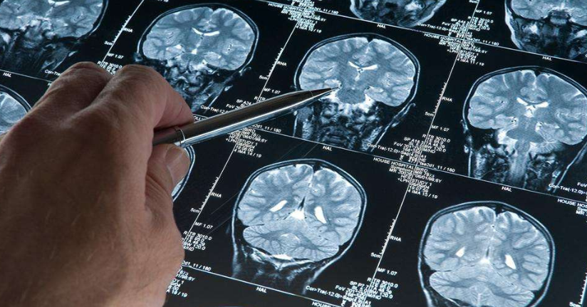 Alzheimer hastalığını erken evrede tespit edebilen kan testi geliştirildi