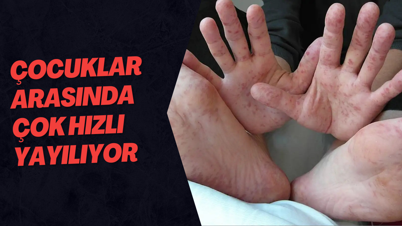 Çocuklar Arasında Çok Hızlı Yayılıyor 