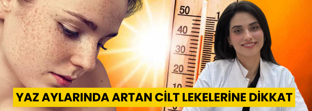 Yaz Aylarında Artan Cilt Lekelerine Dikkat