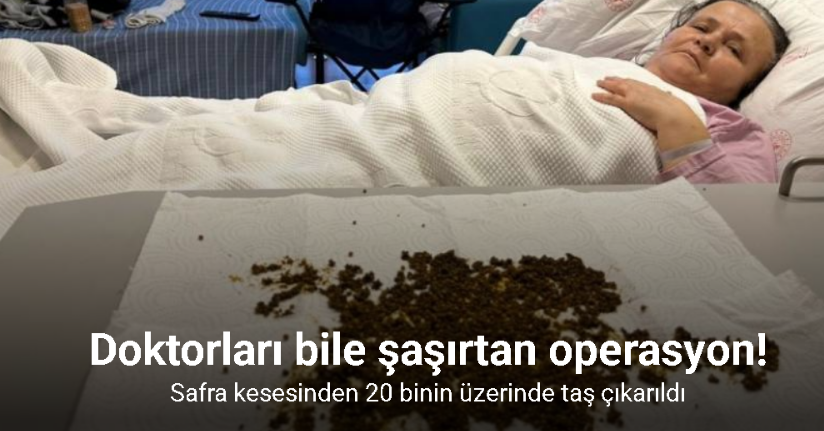 Hastadan çıkan taşları sayamadılar