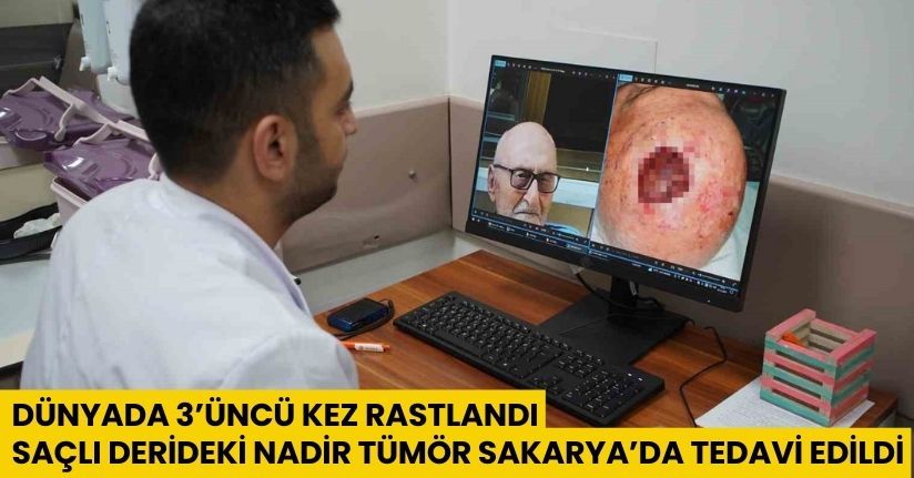 Dünyada 3’üncü kez rastlandı: Saçlı derideki nadir tümör Sakarya’da tedavi edildi