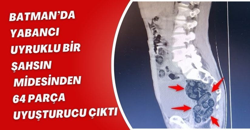 Batman’da yabancı uyruklu bir şahsın midesinden 64 parça uyuşturucu çıktı