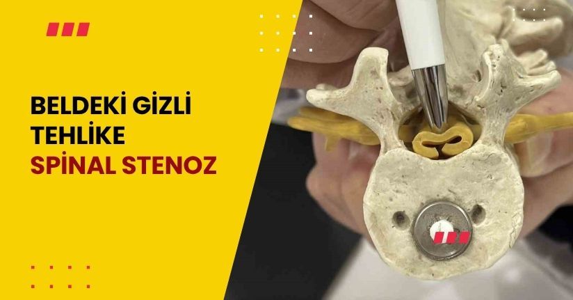 Beldeki gizli tehlike: Spinal stenoz