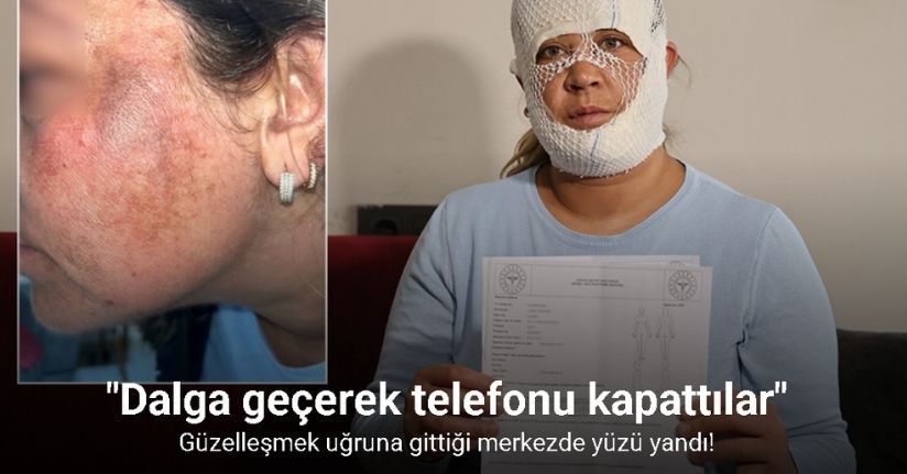 Güzelleşmek uğruna gittiği merkezde yüzü yandı