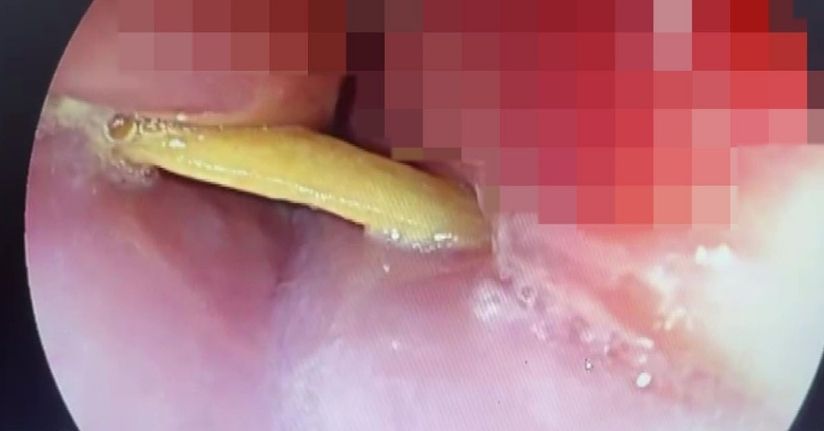 Boğazına saplanan 5 santimlik kemik öldürüyordu