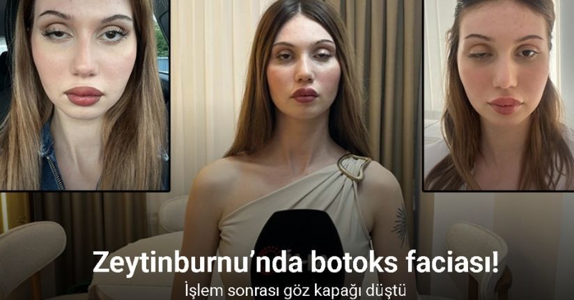 Zeytinburnu’nda botoks yaptıran kadının işlem sonrası göz kapağı düştü