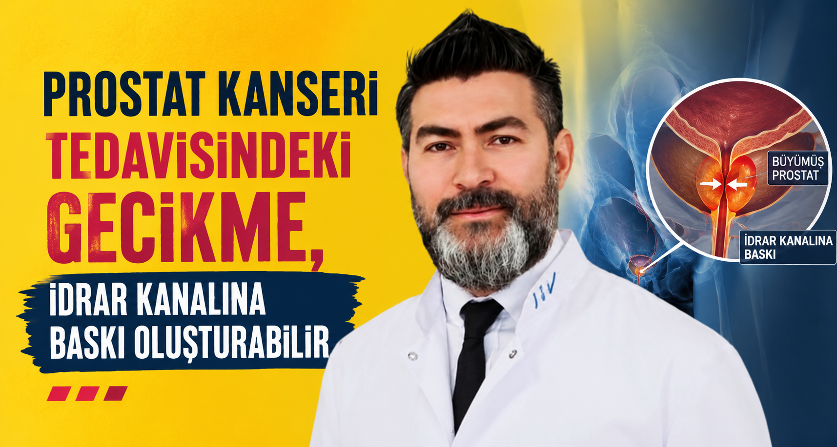 Prostat kanseri tedavisindeki gecikme, idrar kanalına baskı oluşturabilir
