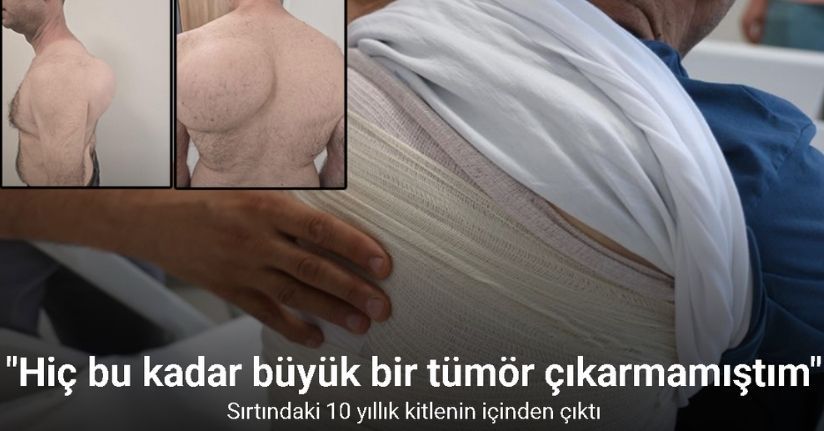 Sırtındaki 10 yıllık kitlenin içinden 1 buçuk kilogramlık tümör çıktı