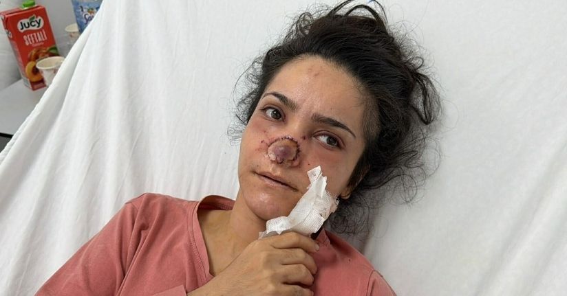 Eşi tarafından burnu ısırılıp koparılan İmran: Acıyla balkondan atlamayı bile düşündüm