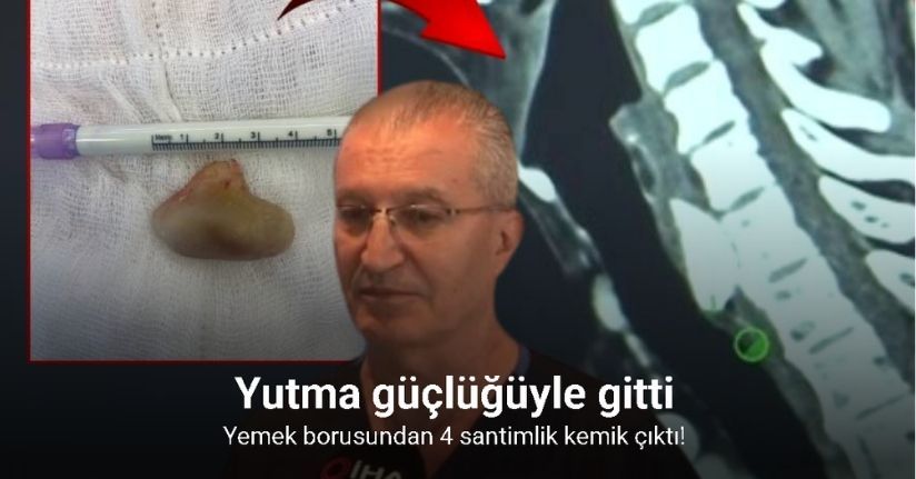 Yutma güçlüğüyle gitti, yemek borusundan 4 santimlik kemik çıktı