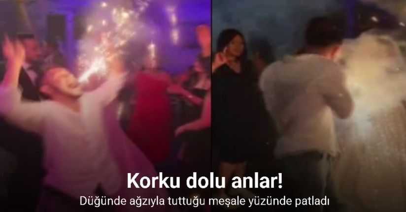 Düğünde ağzıyla tuttuğu meşale yüzünde patladı